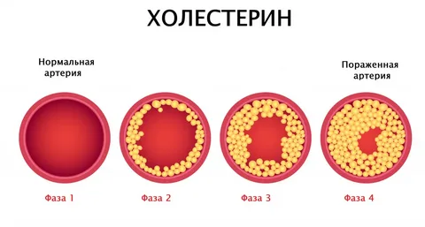 Высокий холестерин - в чем опасность